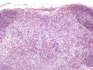 Dermatopathic Lymphadenopathy 1.
