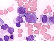 Refractory Anemia with Excess Blasts 2.