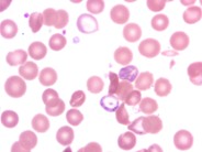 Basophilic Stippling Lead Poisoning 2.