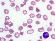 Spur Cell Anemia 2.