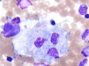 Gaucher's Disease 3.