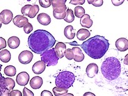 Dyserythropoiesis 1.