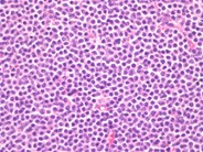 Marginal Zone Lymphoma 2.
