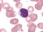 Clefted Lymphocyte 1.