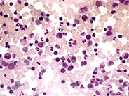 Normal Bone Marrow Aspirate 1.