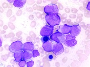 APL in NiemannPick Disease 2.