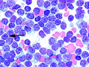 Chronic Lymphocytic Leukemia 3.