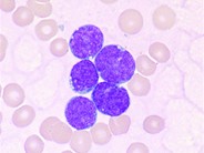 Precursor Bcell Acute Lymphoblastic Leukemia 2.