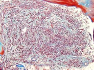 Bone Marrow Fibrosis 3.