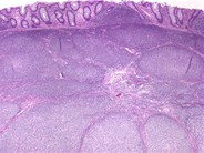 Follicular lymphoma (grade 1/3) in a hepatic flexure polyp 2.