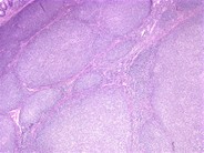 Follicular lymphoma (grade 1/3) in a hepatic flexure polyp 3.