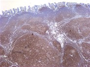 Follicular lymphoma (grade 1/3) in a hepatic flexure polyp 5.