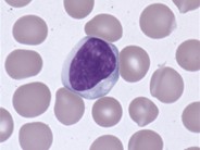 What Are Atypical Lymphocytes