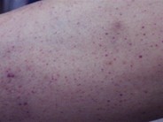 Petechiae 2.