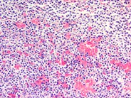 Hairy cell leukemia involving the spleen 3.