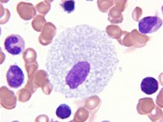 Bone marrow involvement in Niemann Pick disease 3.