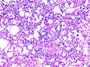 Bone marrow involvement in Niemann Pick disease 6.