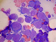 Intravascular lymphoma cells in the bone marrow smears 2.