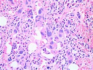 Myelofibrosis associated osteomyelosclerosis 4.