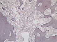 Myelofibrosis associated osteomyelosclerosis 5.