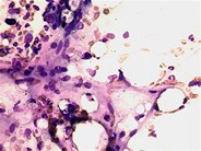 GVHDbone marrow aspirate 2.