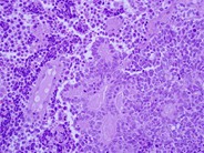 Smallcell neuroendocrine carcinoma with bone marrow and peripheral