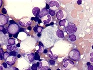 Gaucher’s disease 1.