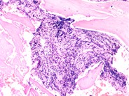 Marrow fibrosis in primary myelofibrosis 1.