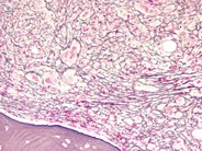 Marrow fibrosis in primary myelofibrosis 2.