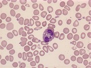 Eosinophils Low