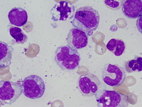 Chronic myelomonocytic leukemia 1 (CMML1) 3