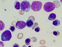 Refractory anemia with excess blasts 1 (RAEB1) 4