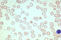Iron Deficiency Anemia Smear