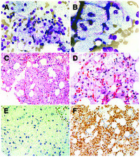Familial hypertriglyceridemia manifests with pancytopenia and bone