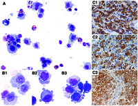 Cellular morphology of BRAF V600Epositive Langerhans cell histiocytosis