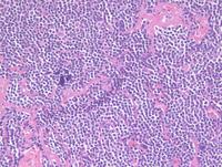 WarthinFinkeldey giant cells 2