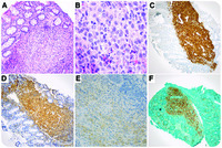 Incidental Langerhans cell histiocytosis of the colon with BRAF p.V600E