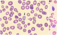 Cabot rings and marked anisopoikilocytosis in ImerslundGräsbeck syndrome