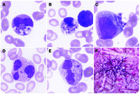 Talaromyces marneffei and dysplastic neutrophils on blood smear in