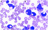 Frequent erythrophagocytosis by leukemic blasts in Bcell acute
