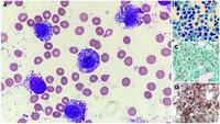 Leukemicphase progression of aleukemic mast cell leukemia