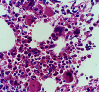 Immune thrombocytopenic purpura (ITP) bone marrow biopsy