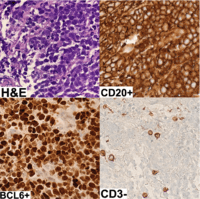 Hepatic Large Bcell Lymphoma