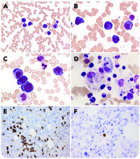 HHV8associated lymphoproliferative disorder in the peripheral blood