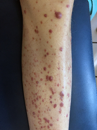 Leukemia Cutis Clinical Presentation 2