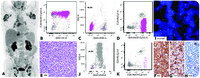Tcell prolymphocytic leukemia negative for surface CD3