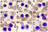 Internuclear bridging outside of primary myelodysplasia and congenital