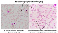 Atypical Microangiopathic Hemolytic Anemia Case report
