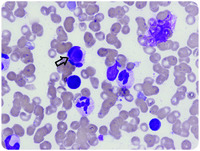 Unexpected bone marrow findings in a patient with