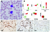 Giant intracytoplasmic inclusions in a Tcell large granular
